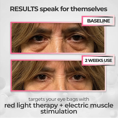 RevitalEyes® Dual Red Light Therapy + EMS To Erase Eye Bags