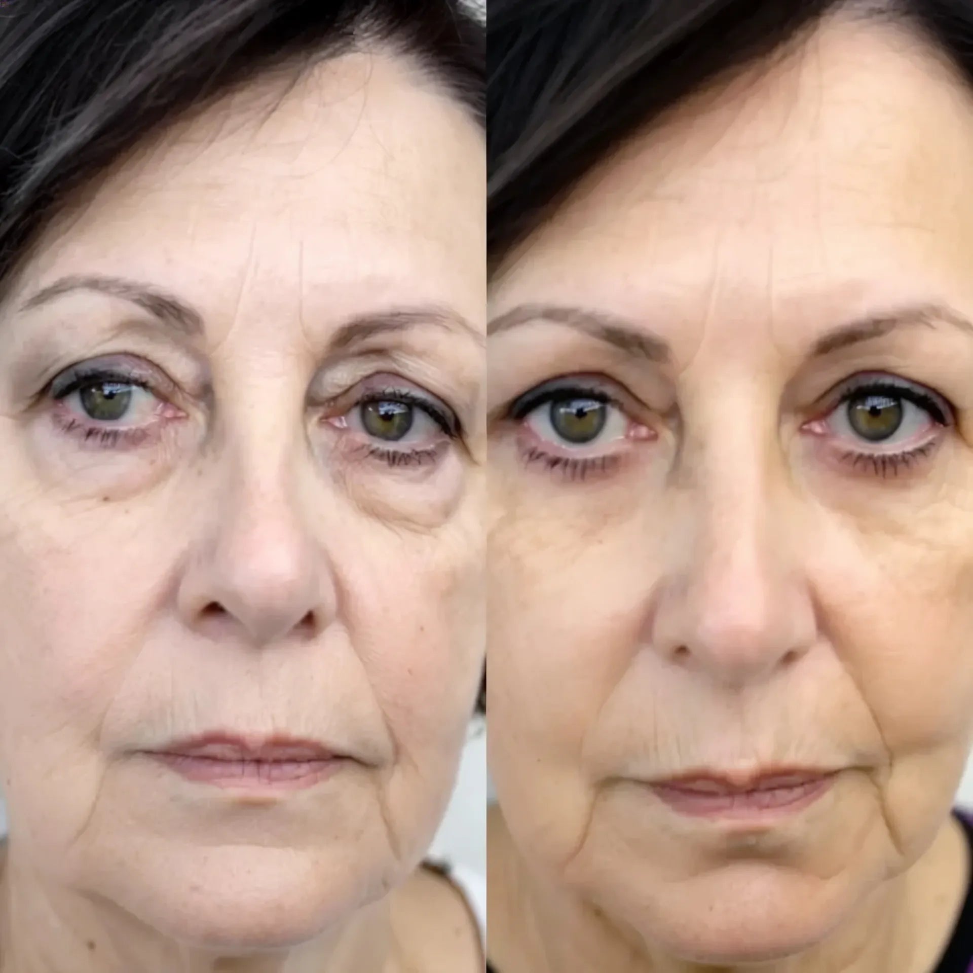 RevitalEyes® Dual Red Light Therapy + EMS To Erase Eye Bags